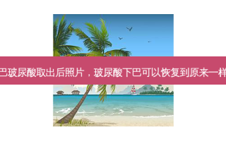下巴玻尿酸取出后照片，玻尿酸下巴可以恢复到原来一样吗