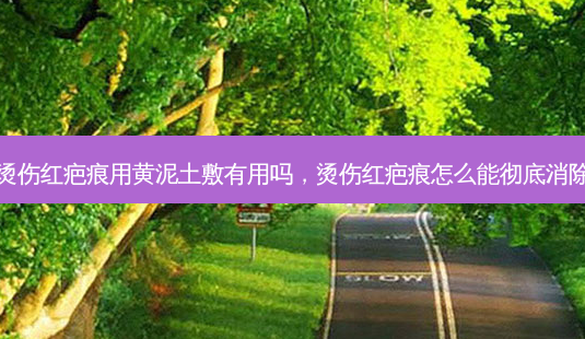 烫伤红疤痕用黄泥土敷有用吗,烫伤红疤痕怎么能彻底消除-第1张图片-南山整形网 烫伤红疤痕用黄泥土敷有用吗,烫伤红疤痕怎么能彻底消除-第1张图片-南山整形网