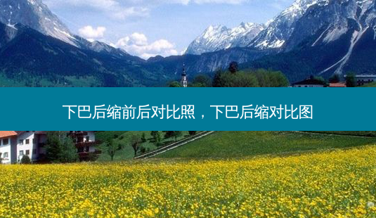 下巴后缩前后对比照,下巴后缩对比图-第1张图片-南山整形网 下巴后缩前后对比照,下巴后缩对比图-第1张图片-南山整形网