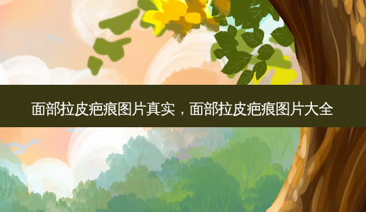 面部拉皮疤痕图片真实,面部拉皮疤痕图片大全-第1张图片-南山整形网 面部拉皮疤痕图片真实,面部拉皮疤痕图片大全-第1张图片-南山整形网
