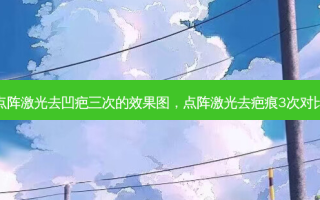 点阵激光去凹疤三次的效果图，点阵激光去疤痕3次对比