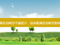 假体隆胸双泡畸形平躺图片，假体隆胸双泡畸形影响生活吗