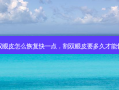 割双眼皮怎么恢复快一点，割双眼皮要多久才能恢复